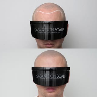 Another hair loss transformation using scalp micropigmentation SMP 💉

Not sure if SMP is right for 