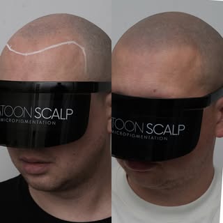 Confidence restored, one follicle at a time. 💉

SASKATOON SCALP
In the business of changing lives �