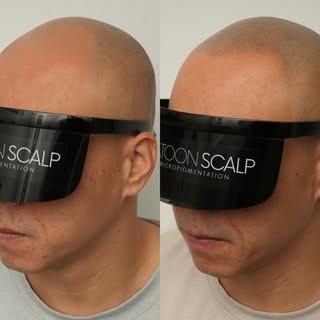 2 weeks healed Scalp Micropigmentation SMP 💉💉

SASKATOON SCALP
In the business of changing lives �