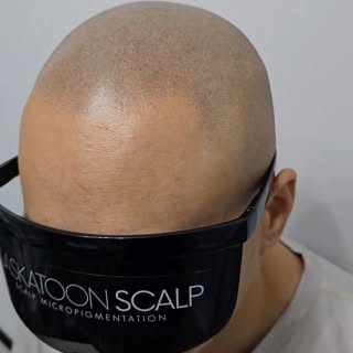 Scalp Micropigmentation SMP 2 weeks post treatment 💉

SASKATOON SCALP
In the business of changing l