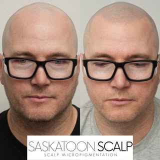 SASKATOON SCALP
In the business of changing lives 🙌

SMP is a revolutionary non-surgical treatment 