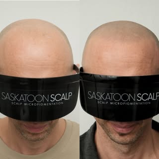 SASKATOON SCALP
In the business of changing lives 🙌

SMP is a revolutionary non-surgical treatment 