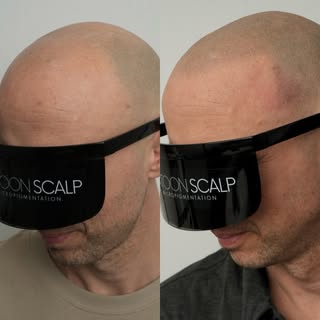 SASKATOON SCALP
In the business of changing lives 🙌

SMP is a revolutionary non-surgical treatment 