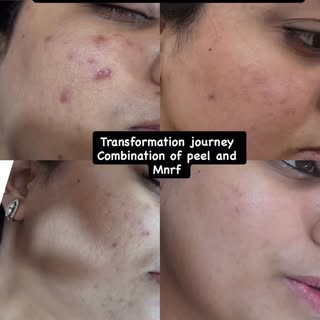 ✨ From Breakouts to Clear, Glowing Skin ✨
Acne can leave behind scars—on your skin and your confiden