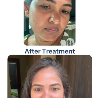 🧴 Benefits of a chemical peel:
✨ Refines skin texture and minimizes pores
🌿 Fades dark spots and p