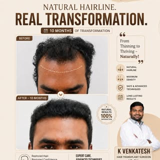 10 MONTHS ONE NATURAL TRANSFORMATION. ✨

From a receding hairline to a fuller, more natural-looking 