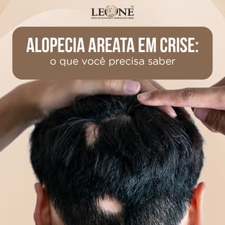 A alopecia areata é uma condição autoimune em que o próprio organismo passa a atacar os folículos ca