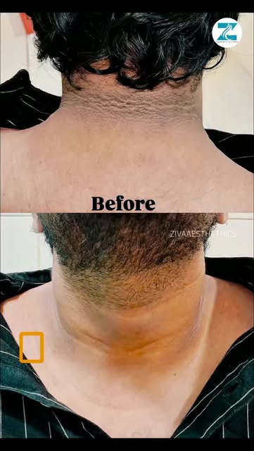 Dark neck after weight gain? ✨

Dark and thick skin on the neck can sometimes be linked to insulin r