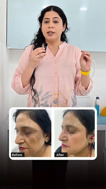 Those patches that don't fade even with makeup, do you know why they show up?

Melasma isn't just "s