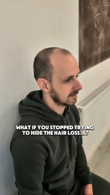 What if you stopped trying to hide the hair loss?
…and chose a solution that made it look like you j