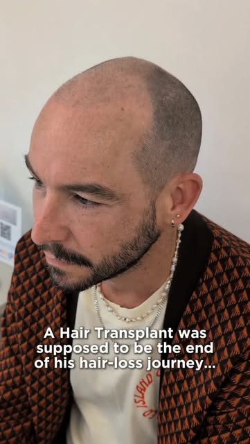 A Hair Transplant was supposed to be the end of his hair-loss journey… but unfortunately, it didn’t 