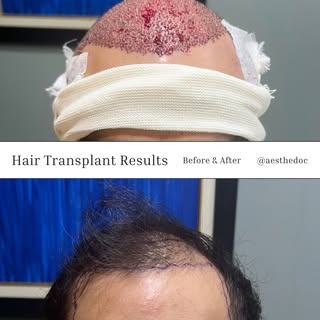 Hair Transplant in Pakistan – A Permanent Solution for Hair Loss

Hair loss can affect confidence an