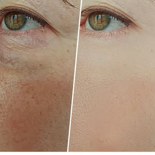 Skin Boosters – Deep Hydration for Healthier, Glowing Skin

Skin Boosters are advanced injectable tr