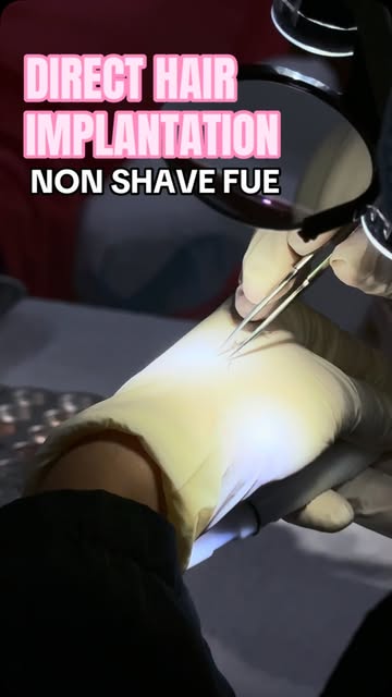 No Shaving Hair Transplant ? No Problem !