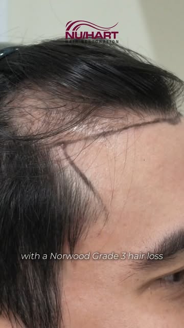 A better hairline doesn’t mean using more grafts than necessary.

For this hair transplant, the goal