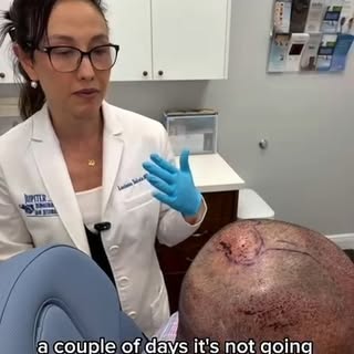 Have you ever wondered about what happens right after an FUE procedure? Dr. Takata had a follow up a
