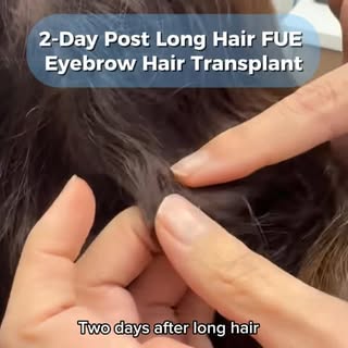 The donor area just 2 days after a long hair FUE eyebrow transplant 

One of the biggest advantages 