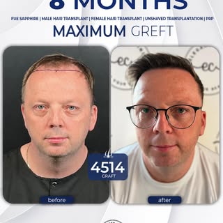 👌 Stunning 8-Month Transformation! 
✨ 4514 Greft 
👨‍⚕️ Performed with the DHI technique, our patie