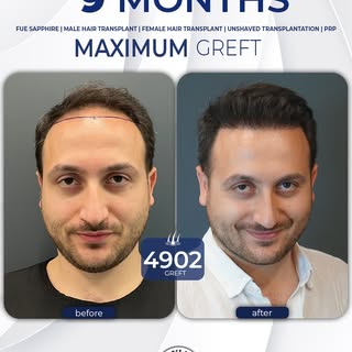 👌 Stunning 9-Month Transformation! 
✨ 4902 Greft 
👨‍⚕️ Performed with the DHI technique, our patie