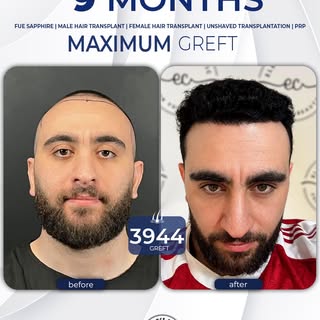 👌 Stunning 9-Month Transformation! 
✨ 3944 Greft 
👨‍⚕️ Performed with the DHI technique, our patie