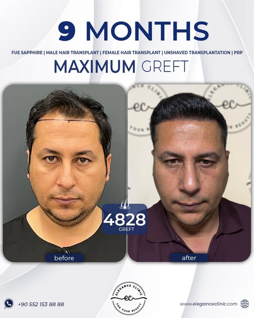 👌 Stunning 9-Month Transformation! 
✨ 4828 Greft 
👨‍⚕️ Performed with the DHI technique, our patie
