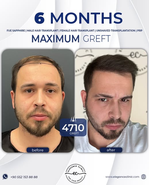 💥 Sadece 6 ayda bu kadar değişim mümkün mü?

Cevap: Evet. 👇

✨ 4710 Greft
👨‍⚕️ DHI tekniğiyle ger