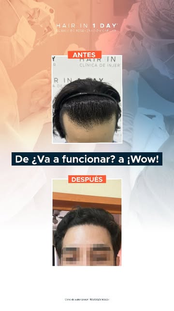 Este es el recorrido de nuestro paciente desde el día del procedimiento hasta lograr los resultados 