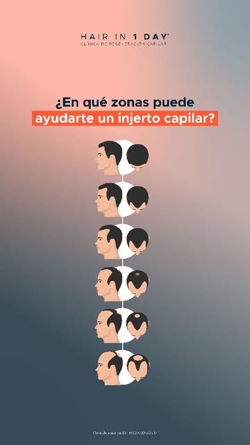 ¿Entradas? ¿Coronilla? ¿Pérdida más avanzada? 🫠😟
La zona y el grado de pérdida importan, porque no