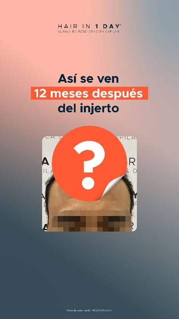 Un día es suficiente para realizar el procedimiento, pero un resultado capilar no se construye de un