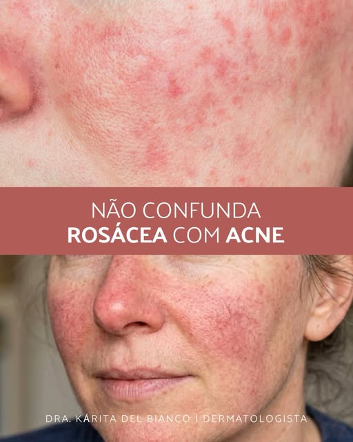🚫 Não confunda rosácea com acne!

Vermelhidão, pústulas e ardência podem até parecer acne…
mas pode