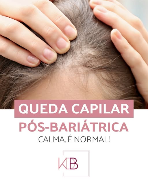 A queda de cabelo após a cirurgia bariátrica é uma das queixas mais comuns no consultório, mas você 