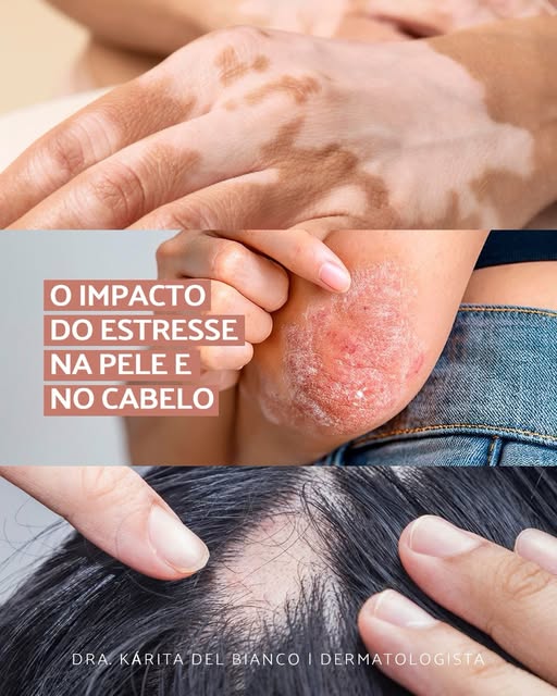 ⚠️ É muito comum ouvirmos por aí que “tal problema apareceu por causa do estresse”. Mas, como dermat