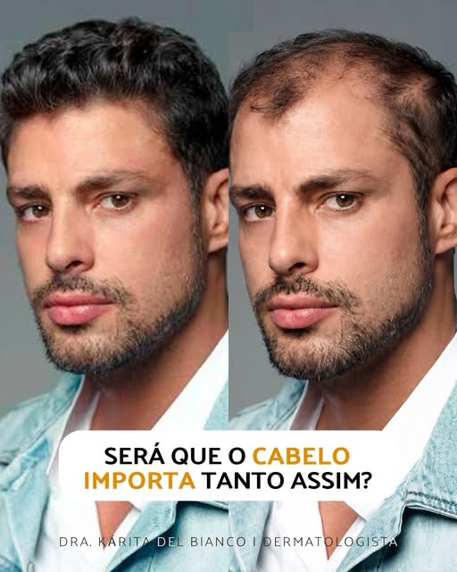 A calvície masculina é tão comum que acabou sendo normalizada. Muitas vezes, o homem ouve que “é ass