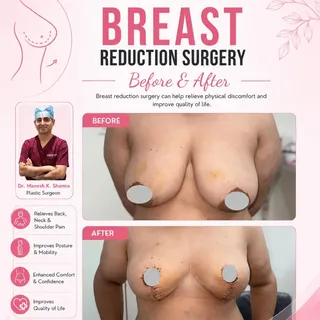 Successfully Performed Breast Reduction Surgery

A successful Breast Reduction Surgery performed by 