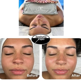 Dermaplaning is a great add-on or stand-alone service to help exfoliate the skin, improve product ab