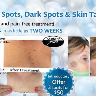 Quick and painless way to remove dark spots, age spots, and skin tags. Gone in about two weeks. Very