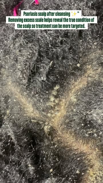 Psoriasis scalp after cleansing ✨”
Removing excess scale helps reveal the true condition of the scal