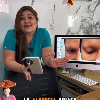 😳💇‍♀️ Te despiertas un día… y aparece un espacio redondo sin cabello. 👀⚠️

La alopecia areata pue