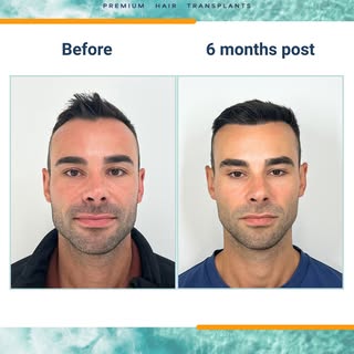 6 months progress ☀️ 

For this hairline restoration, Dr Hamish used 2404 grafts to lower both reces
