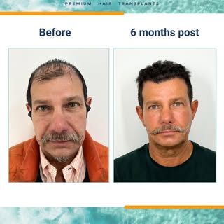 6 months progress ☀️ 

Our lovely patient had experienced advanced hair loss in all three zones, and