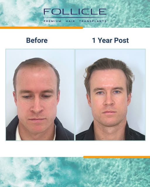 12 months progress ☀️ 

For this lovely patient, Dr Hamish used 3353 grafts to lower the recession p