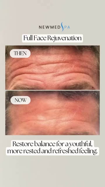 You deserve to feel good when you see yourself in the mirror. 🤍

Full Face Rejuvenation is not abou