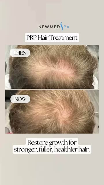 Thinning hair holding you back from feeling like yourself? 💛

PRP Hair Restoration uses your body's