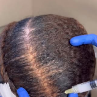 ✨CCCA (Central Centrifugal Cicatricial Alopecia) is a type of scarring hair loss that needs urgent a
