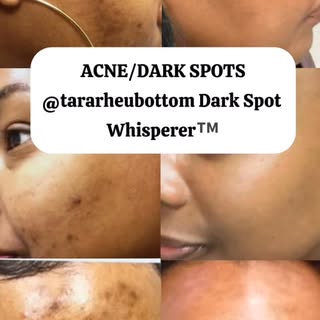 💡ACNE/SCARS/DARK SPOTS @tararheubottom 🔗 booking link in bio #dermatology #skincare #melanin #acne