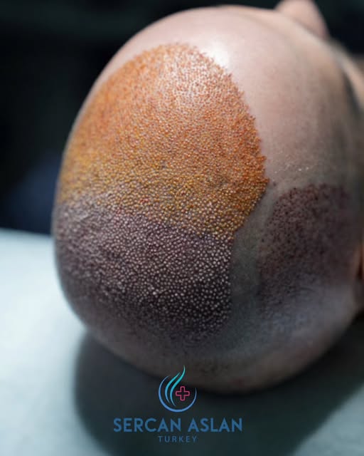 A structured, high-density procedure completed with precision.

This case was performed over two con