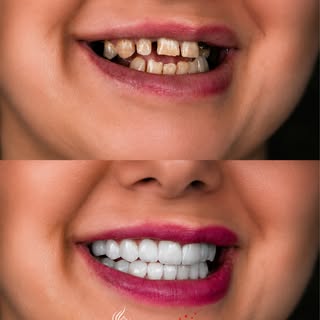 A full smile transformation is not only about whiter teeth it is about rebuilding function, harmony,