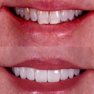 A brighter smile. A more confident you. ✨

Natural looking aesthetics achieved with premium laminate