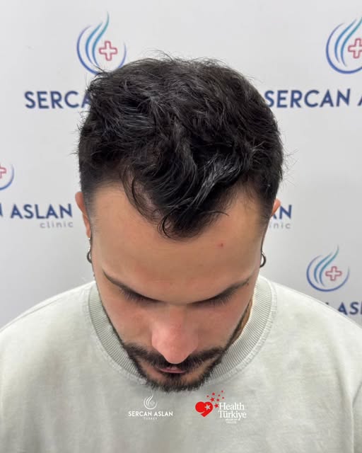 Same person. Different frame.

A well-planned hair transplant should complement the face rather than