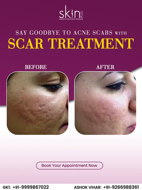 Say goodbye to the appearance of acne scars and hello to smoother, healthier-looking skin ✨
Discover